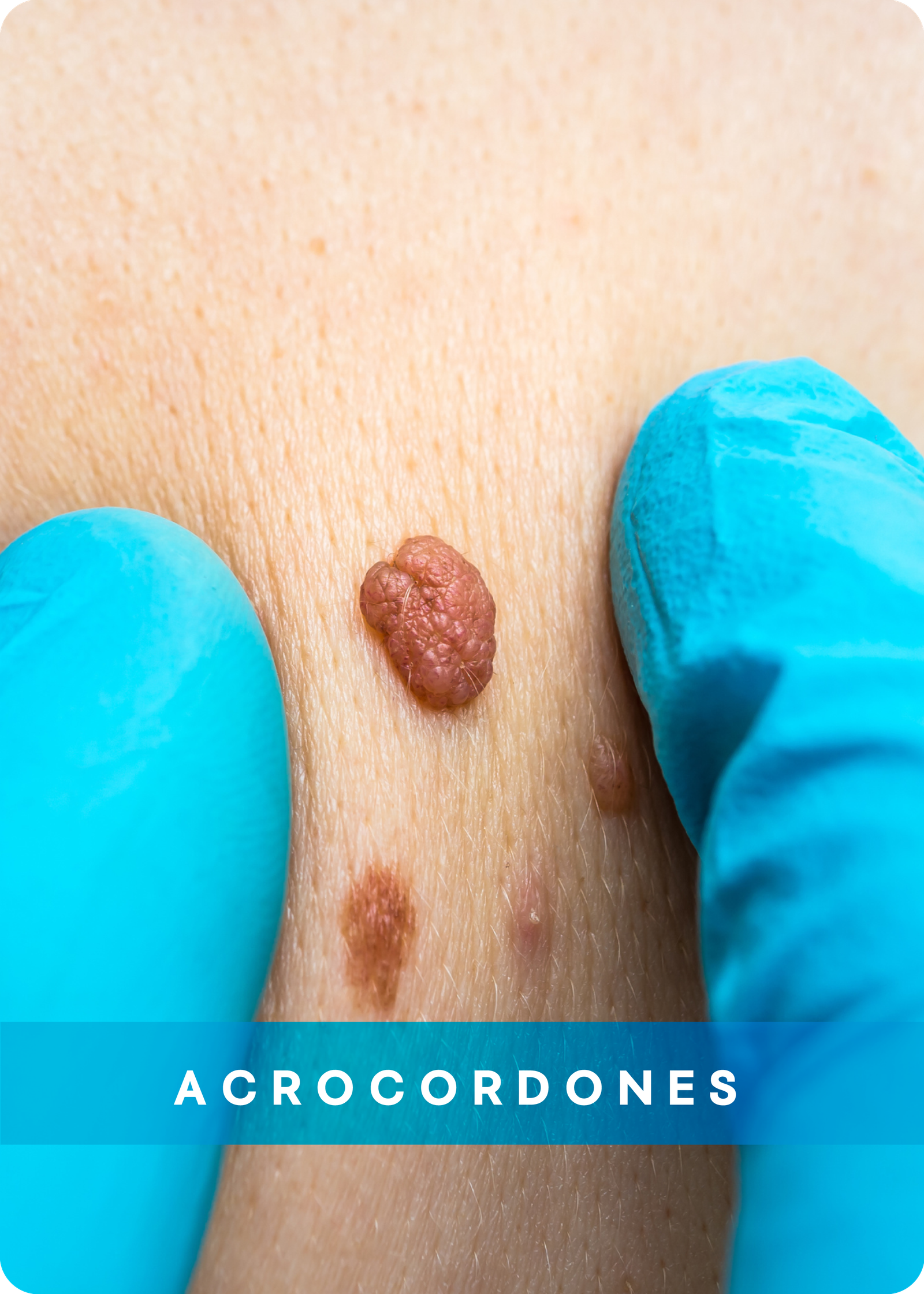 ACROCODONES