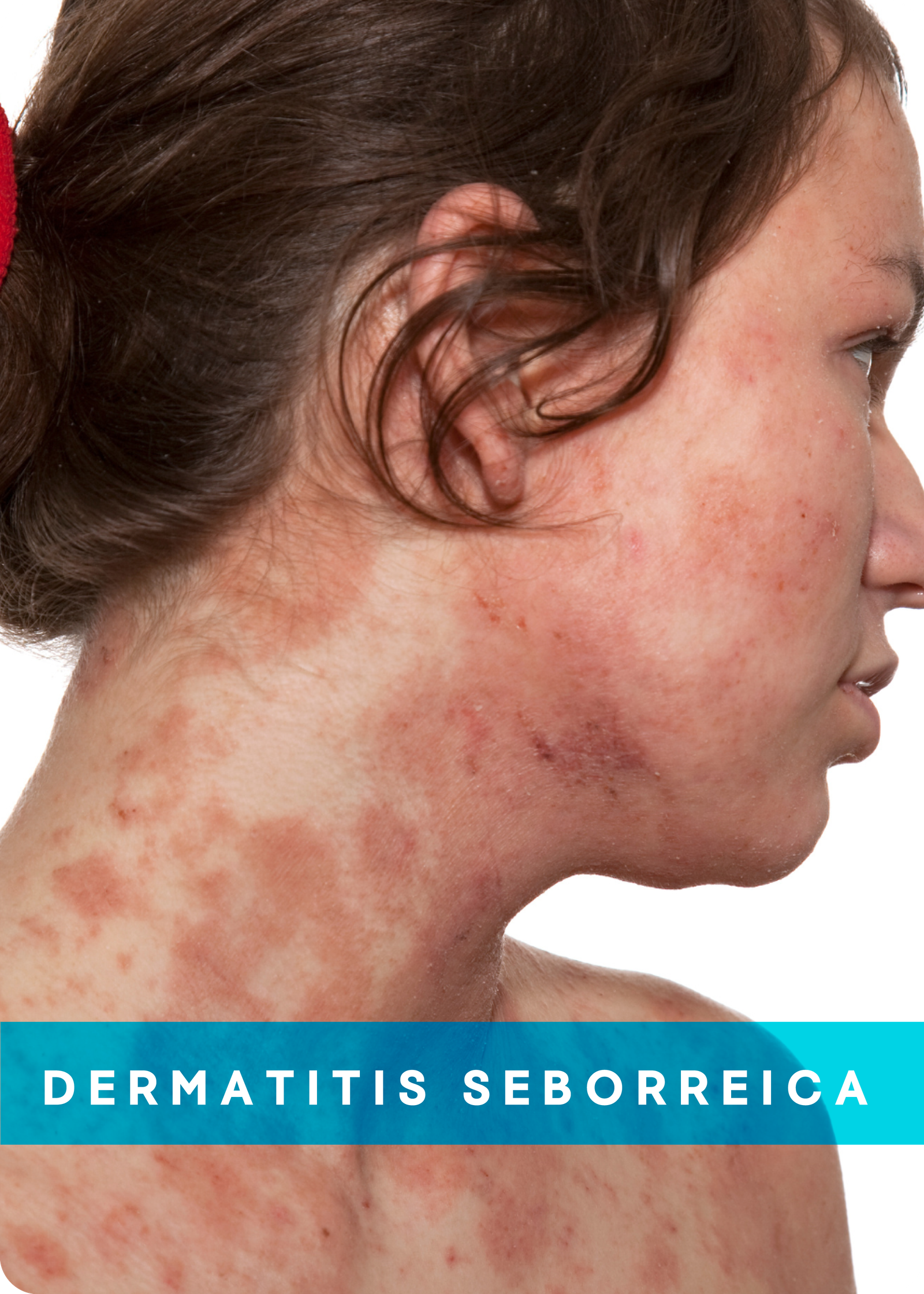 DERMATITIS SEBORREICA