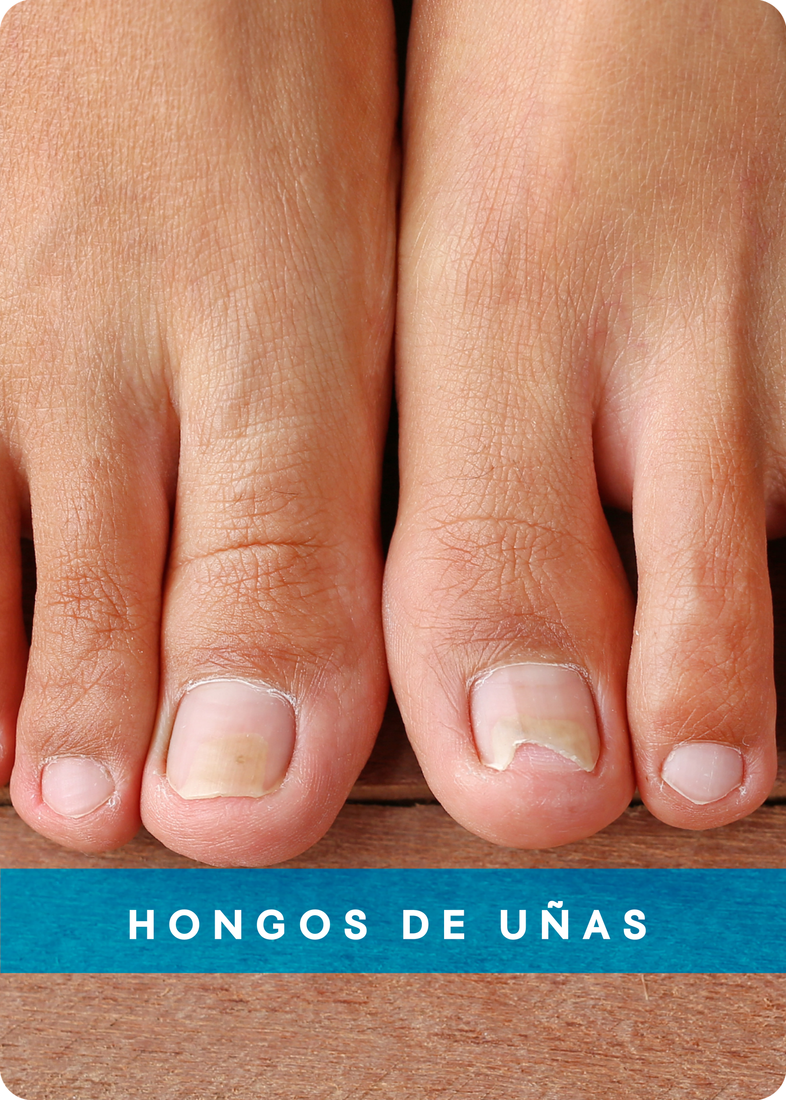 HONGOS DE UÑAS