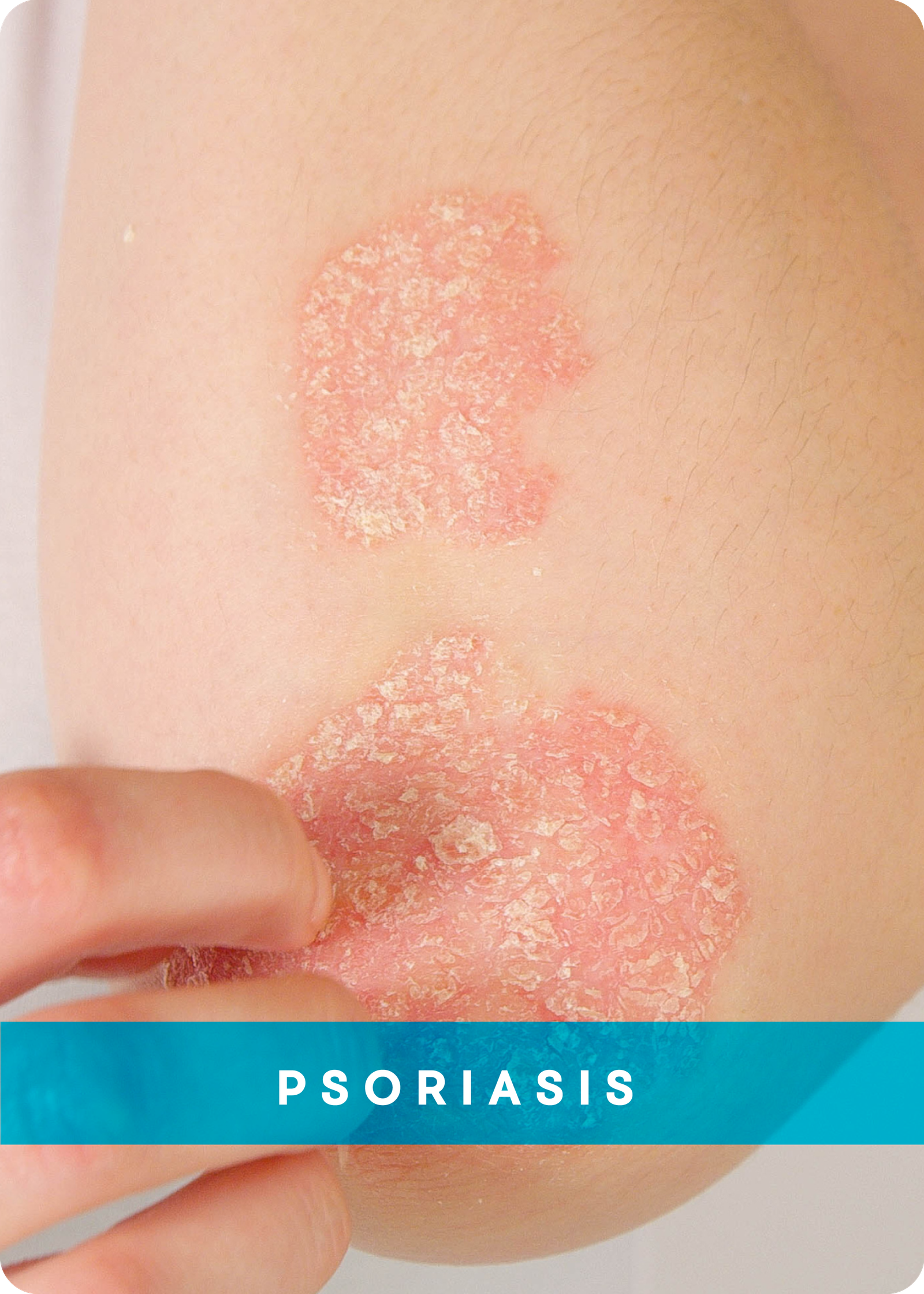 PSORIASIS