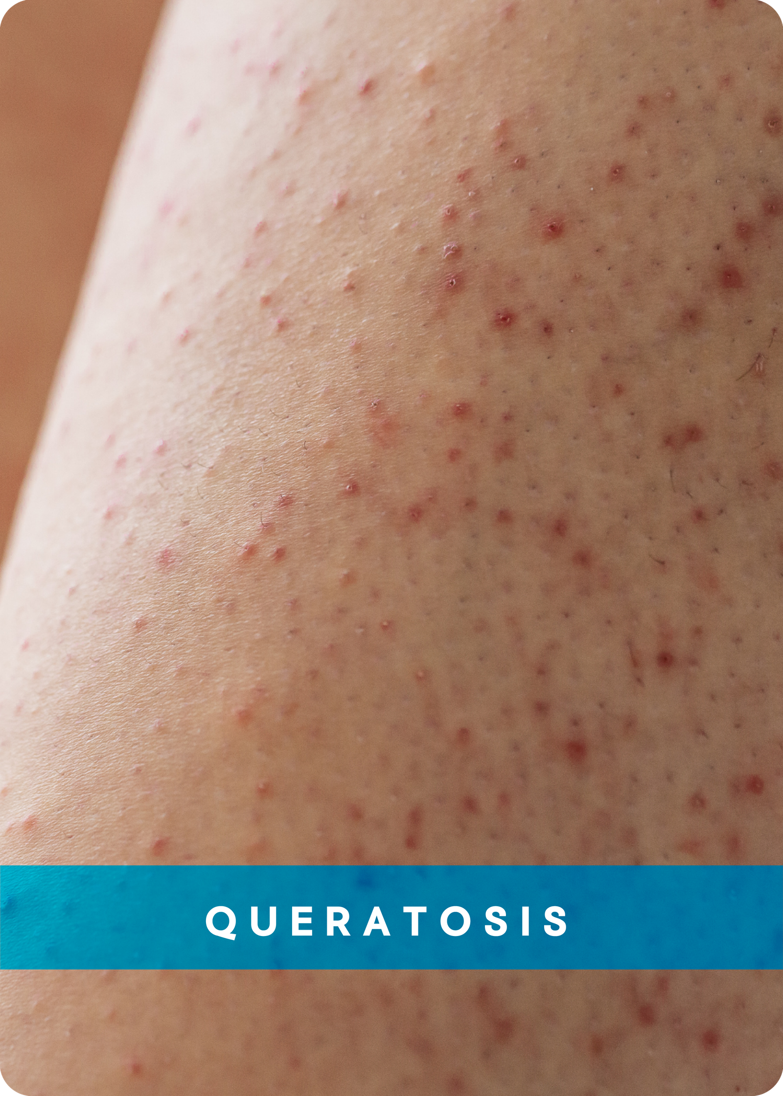 QUERATOSIS