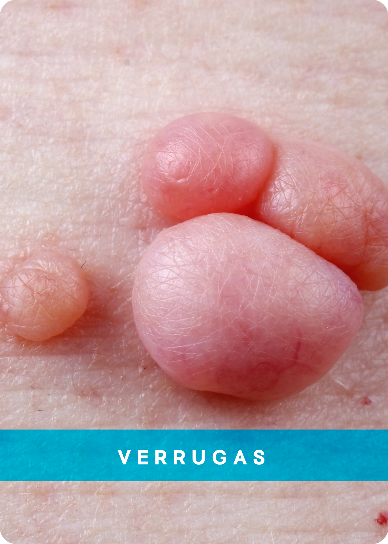 VERRUGAS